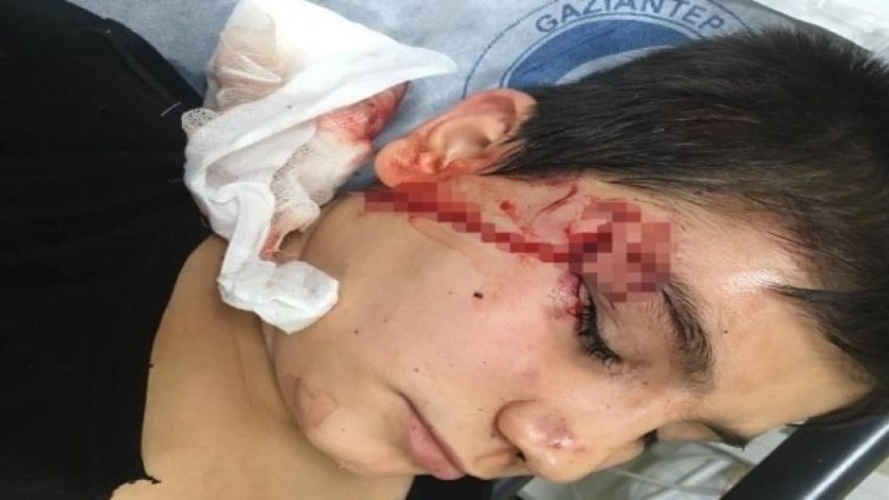 Pitbul'un saldırdığı çocuğu, köpeğin ağzından zor aldılar