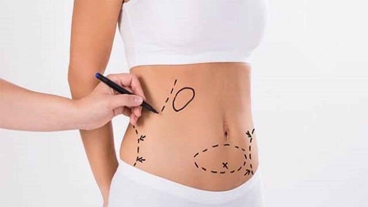 Liposuction Nedir?