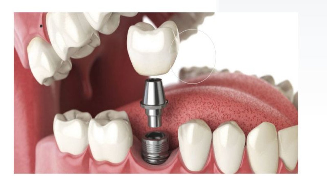 Dişlerinizdeki Sorunlara Profesyonel Çözümler