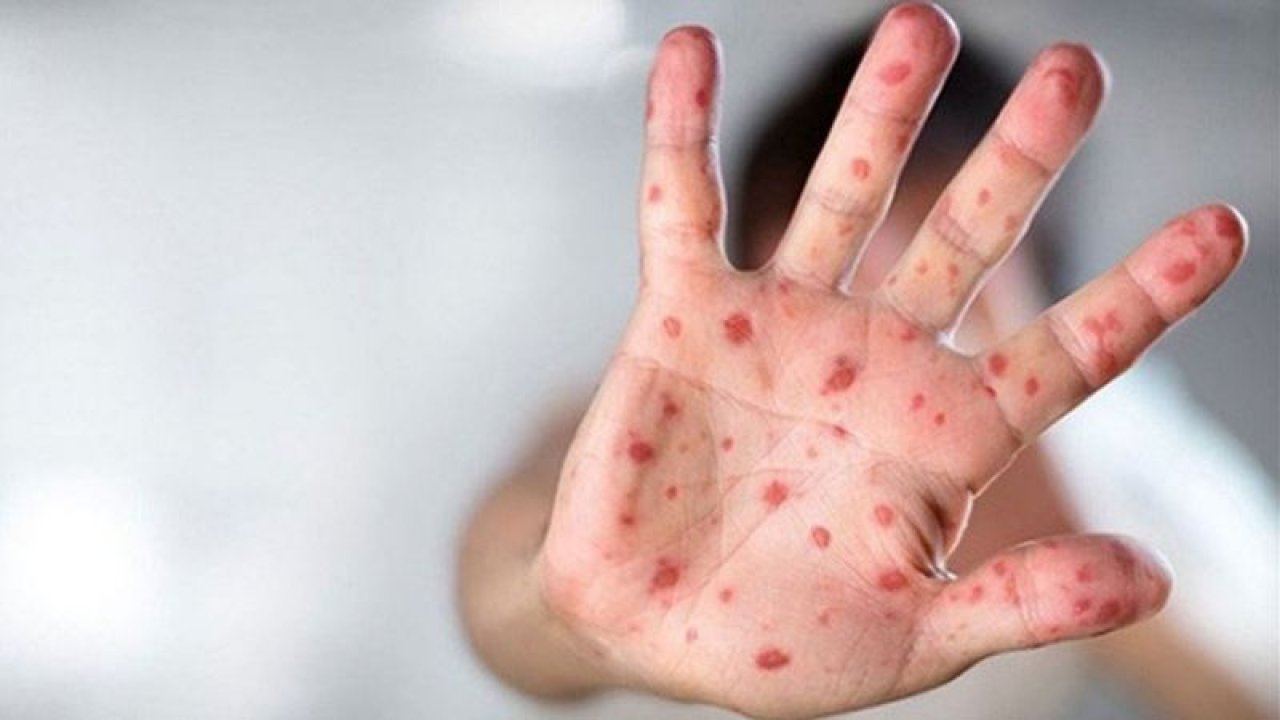 Dikkat! Maymun çiçeği hastalığının habercisi olan belirtilere yenileri eklendi! Çiçek aşısı, maymun çiçeğine karşı yüzde 85 koruyor mu? Video Haber