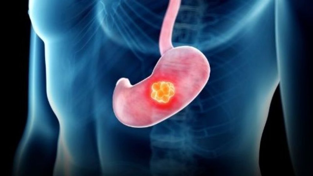 Bu Gıdaları Sofranıza Her Gün Almayın! Mide Kanserinden Korunmak İçin Mutlaka Okuyun! Sağlıklı Sandığınız Gıdalar Bile Listede…