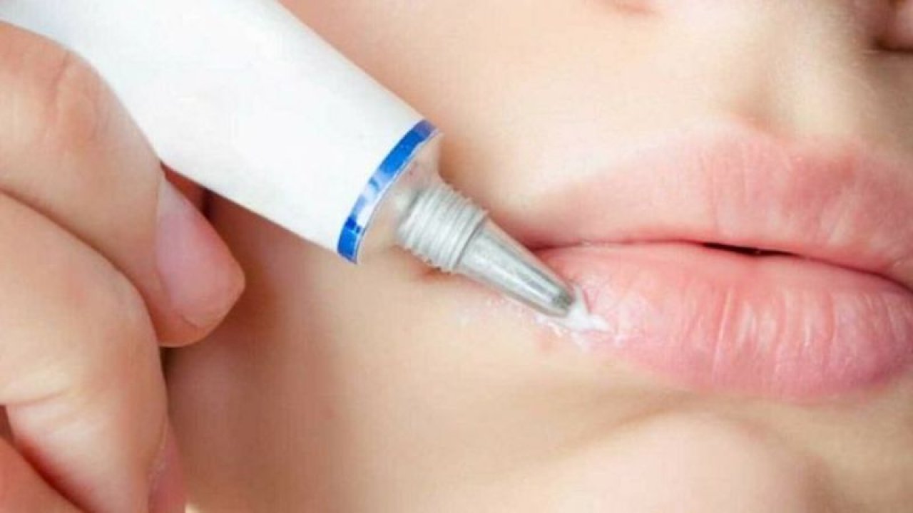 Asiviral Krem Ne İşe Yarar, Ne İçin Kullanılır, Fiyatı Ne Kadar?