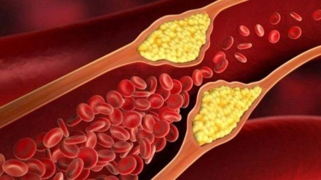 Doktorlar Resmen Açıkladı! Her Yaş Grubunda Görülebiliyor! Damar Tıkanıklığına Karşı Vücudunuzun O Bölgesini Kontrol Edin, Erken Tanı İle Hayatınızı Kurtarın!