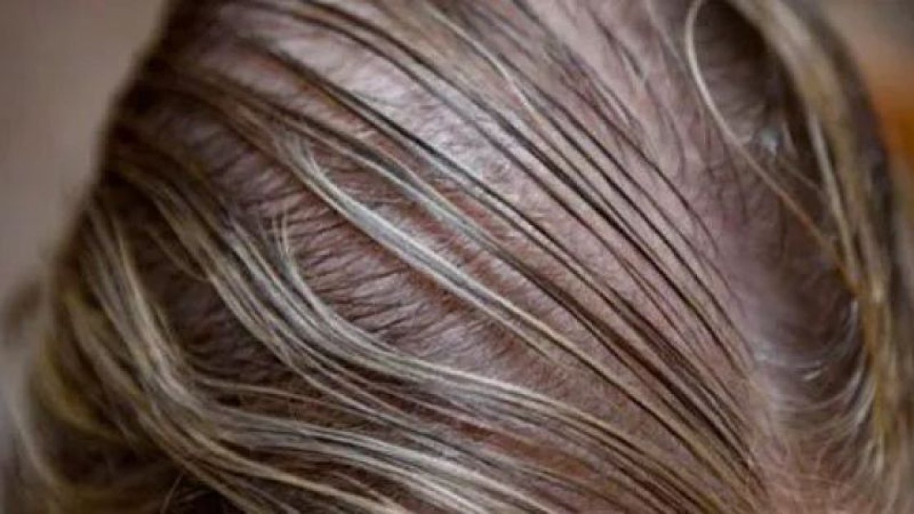 Herkes Pis Zanneder! Yağlı Saçın Faydaları Şok Etti! Tam 17 Gündür Saçlarını Yıkamadı!