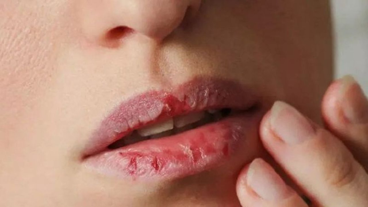 Dudak Çatlamasının Altında Yatan Asıl Neden Ne? Dudak Çatlaması Olanlara Uzmanlardan Uyarılar Geldi!