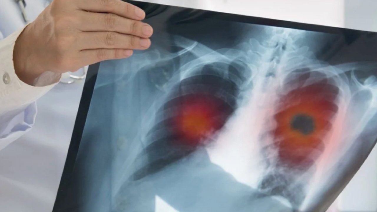 Uzmanından zatürreden korunmak için aşı uyarısı