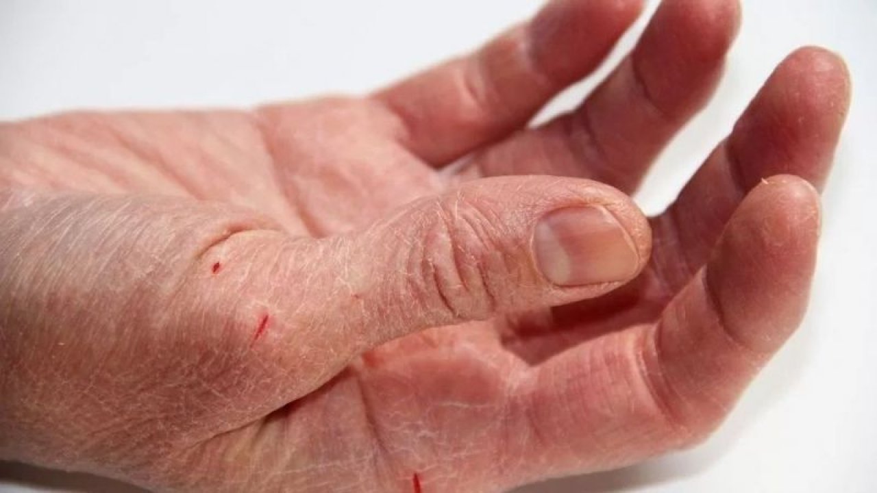 Kuruyan ve Çatlayan Eller İçin Doğal Yöntemler! Bu Üç Yöntem İle Ellerinize İyi Bakın!