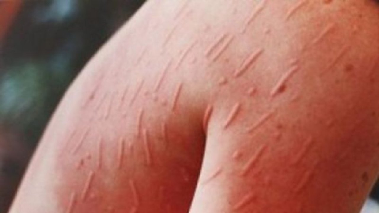 Uyuz Tedavisi Evde Yapılır Mı? İşte Uyuz Tedavisine Dair Merak Edilenler!