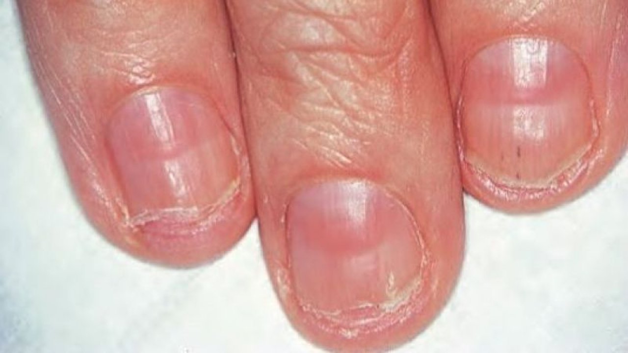 Tırnak Sağlığına Dikkat! Tırnakta Yatay ve Dikey Çizgilerin Altında Birçok Hastalık Olabilir!