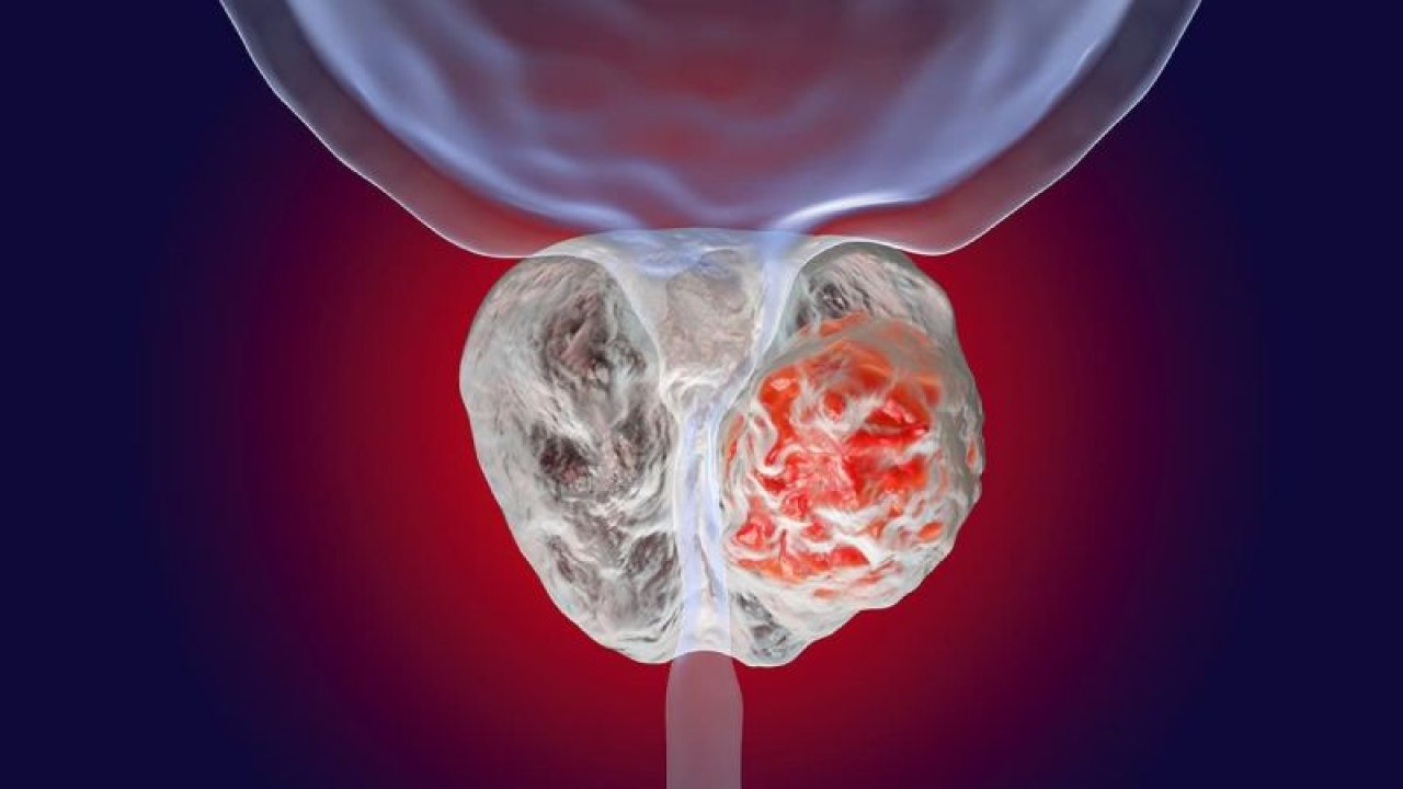 Birçok İnsanın Korkulu Rüyalarından Biri Olan Prostat Kanserinin Tedavi Yolları!