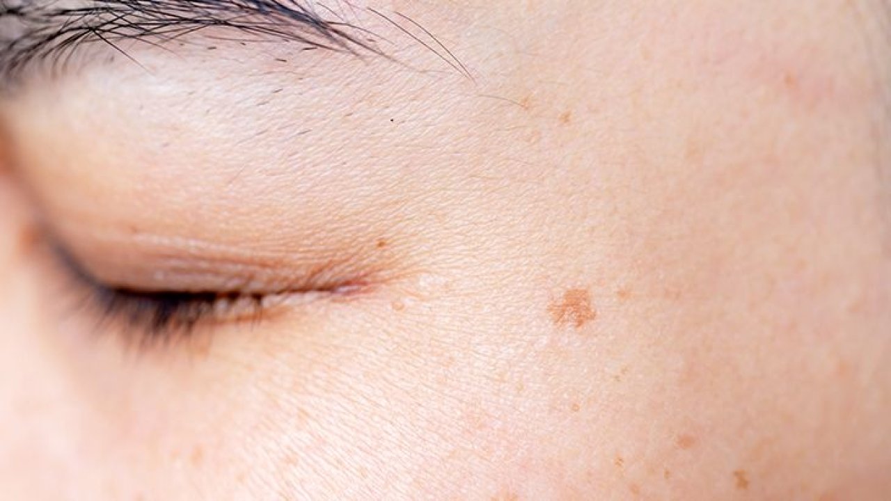 Cilt lekeleri ile başı dertte olanlar dikkat! Yüzdeki lekelerden bu yöntemler ile kurtulabilirsiniz!