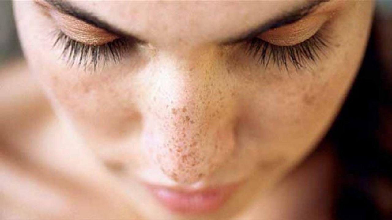Yüzünüzdeki Kahverengi Lekelerden Kurtulun! Uzman İsim Saraçoğlu’ndan Bitkisel Kürler!