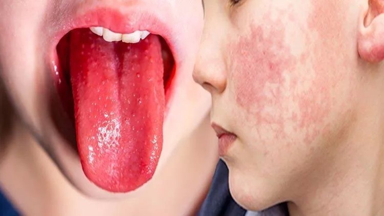 Strep A Enfeksiyonun Görülme Sıklığı Arttı! Çocuklarda Hangi Belirtiler Bu Enfeksiyona İşaret Ediyor?