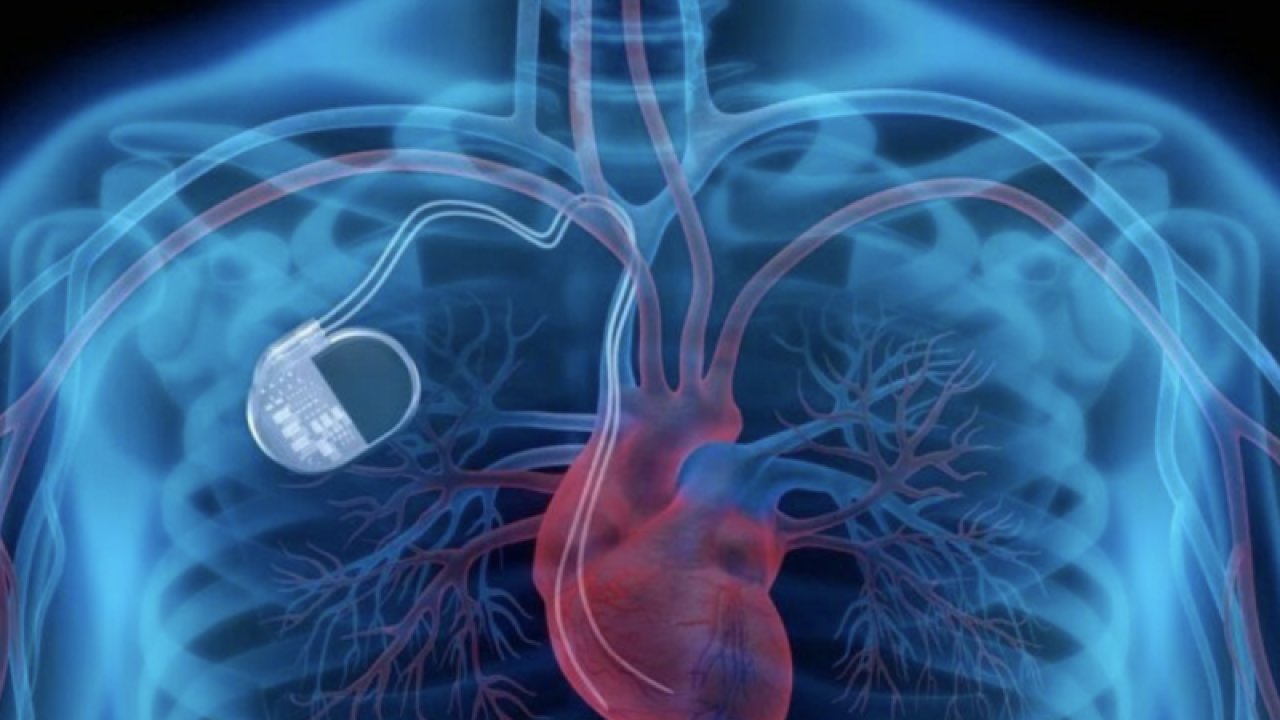 Kalıcı kalp pili olanların uyması gereken 8 kural