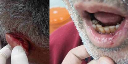 Gaziantep’te Sağlıkçıya Meydan Dayağı: Yardım İstediği İçin Başına 4 Dikiş Atıldı!