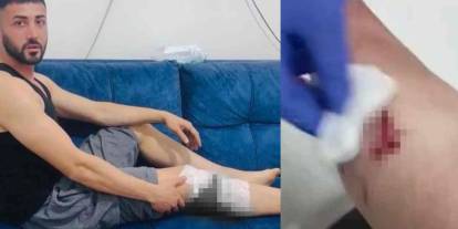 Gaziantep’te Peş Peşe Köpek Saldırıları: 1 Kadın, 2 Kişi Yaralandı